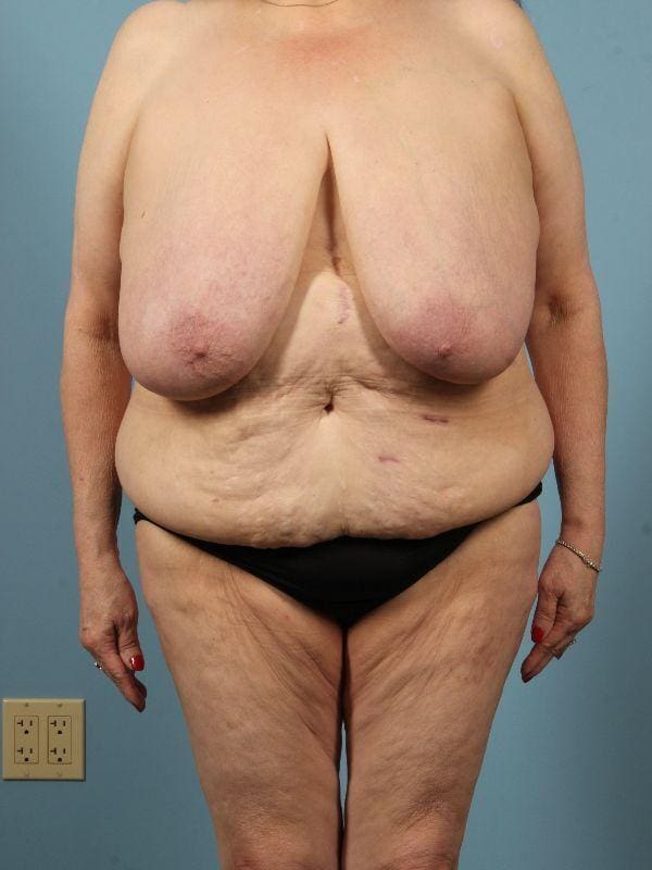 Breast Reduction Patient Photo - Case 13486 - before view-