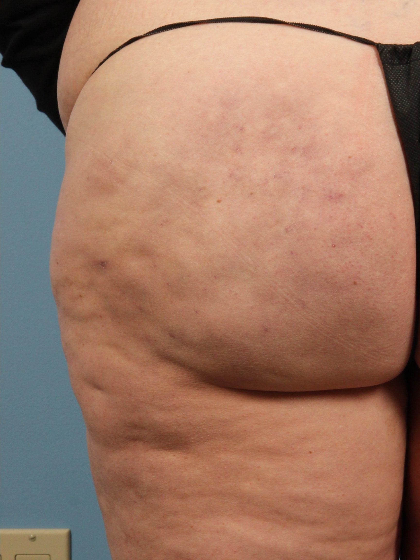 Cellulite Reduction Patient Photo - Case 13498 - after view-1