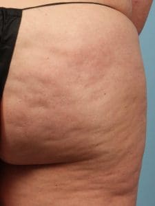 Cellulite Reduction - Case 13498 - Before