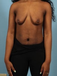 Breast Lift - Case 13538 - Before