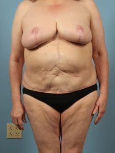 Breast Lift - Case 13560 - After