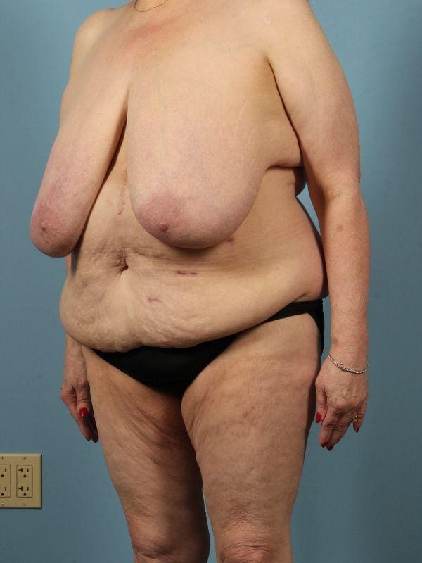 Breast Lift Patient Photo - Case 13560 - before view-3