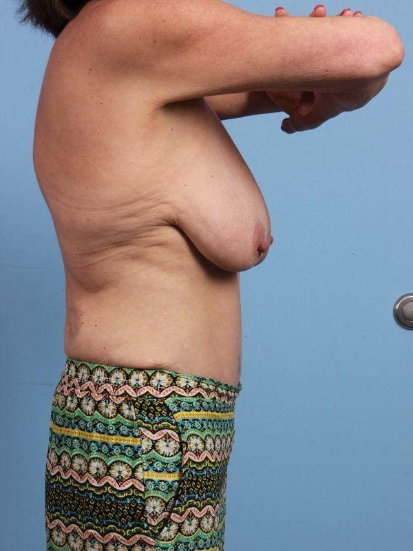 Breast Lift Patient Photo - Case 13633 - before view-2