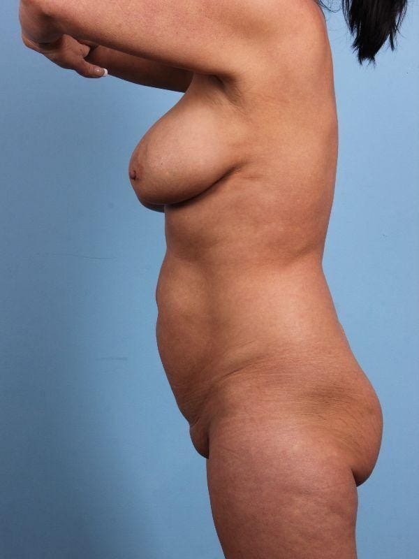 Breast Lift Patient Photo - Case 13645 - before view-1