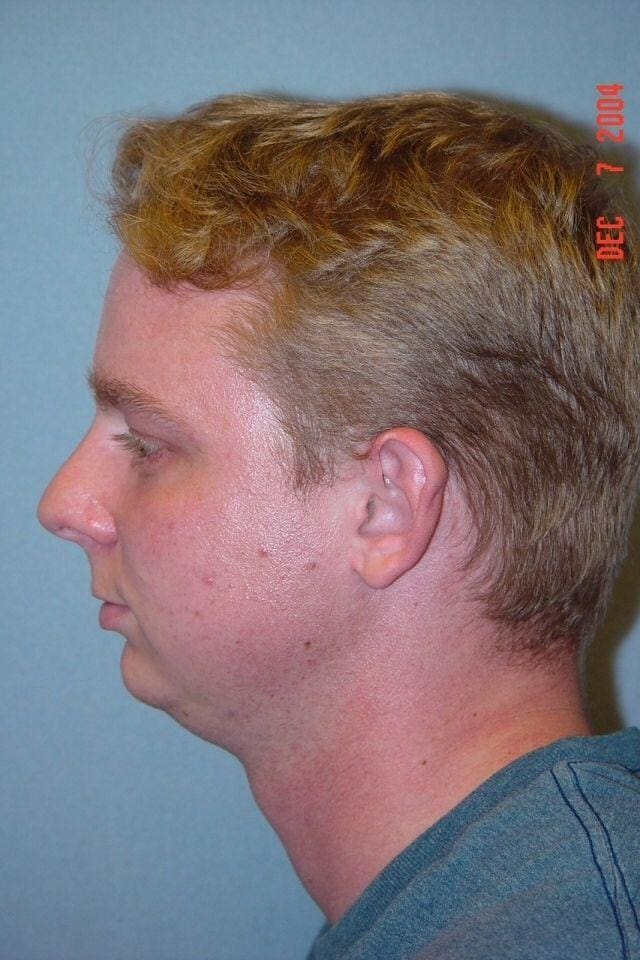 Chin Augmentation Patient Photo - Case 13688 - before view-1