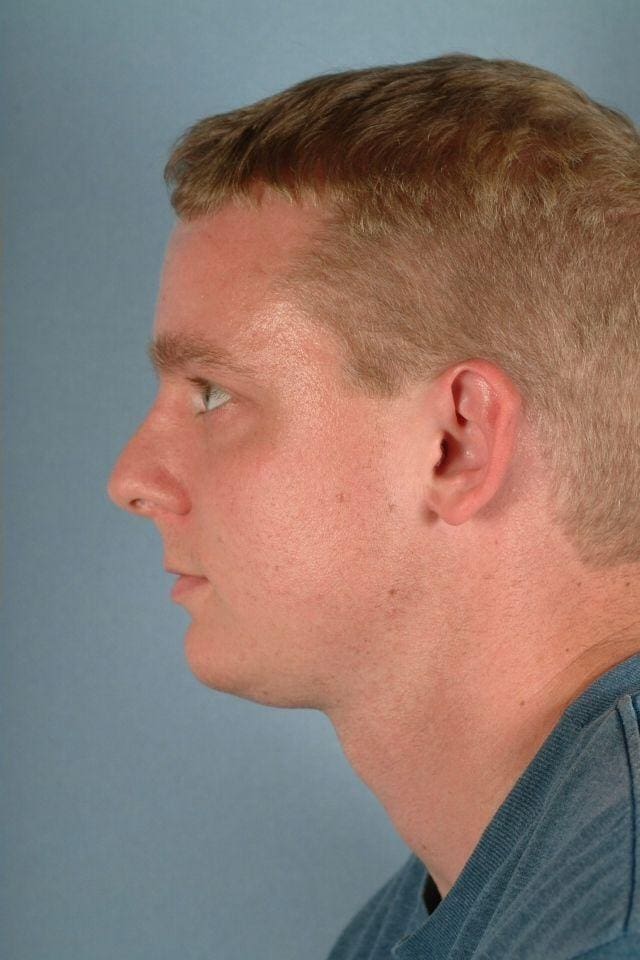 Chin Augmentation Patient Photo - Case 13688 - after view-1