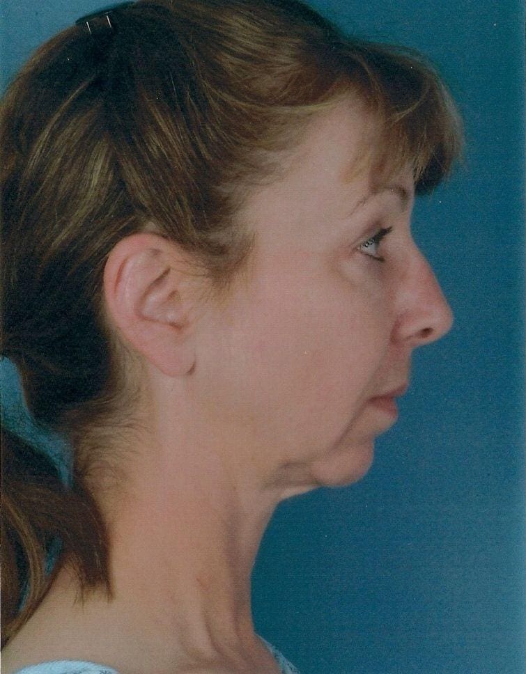 Chin Augmentation Patient Photo - Case 13694 - before view-1