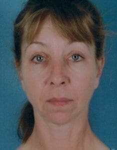 Chin Augmentation - Case 13694 - Before