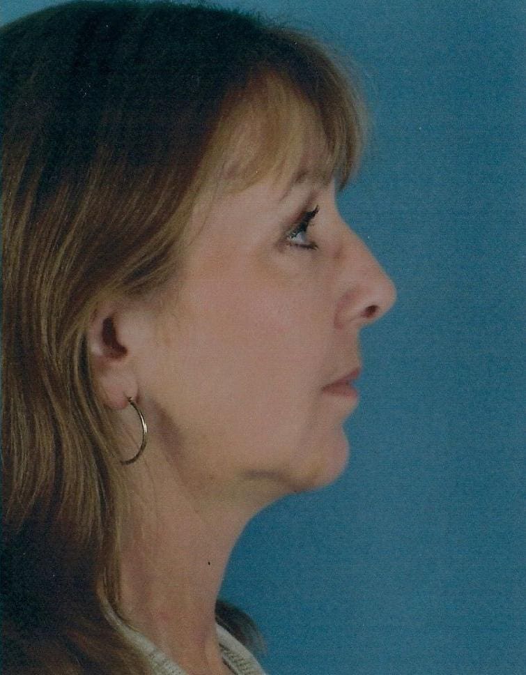 Chin Augmentation Patient Photo - Case 13694 - after view-1