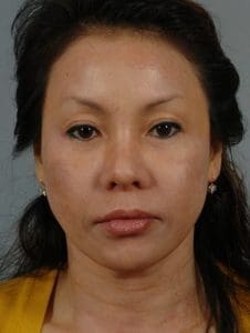 Chin Augmentation - Case 13700 - Before
