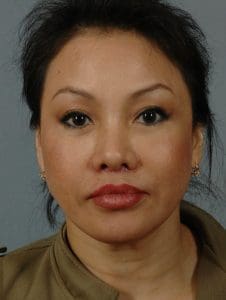 Chin Augmentation - Case 13700 - After