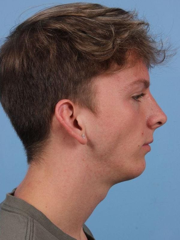 Chin Augmentation Patient Photo - Case 13710 - after view-2
