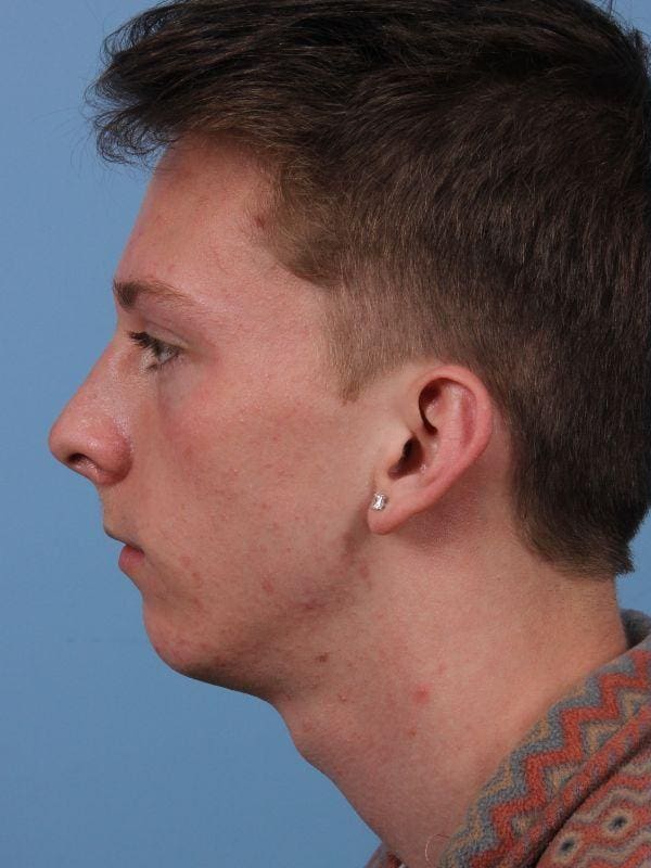 Chin Augmentation Patient Photo - Case 13710 - before view-1