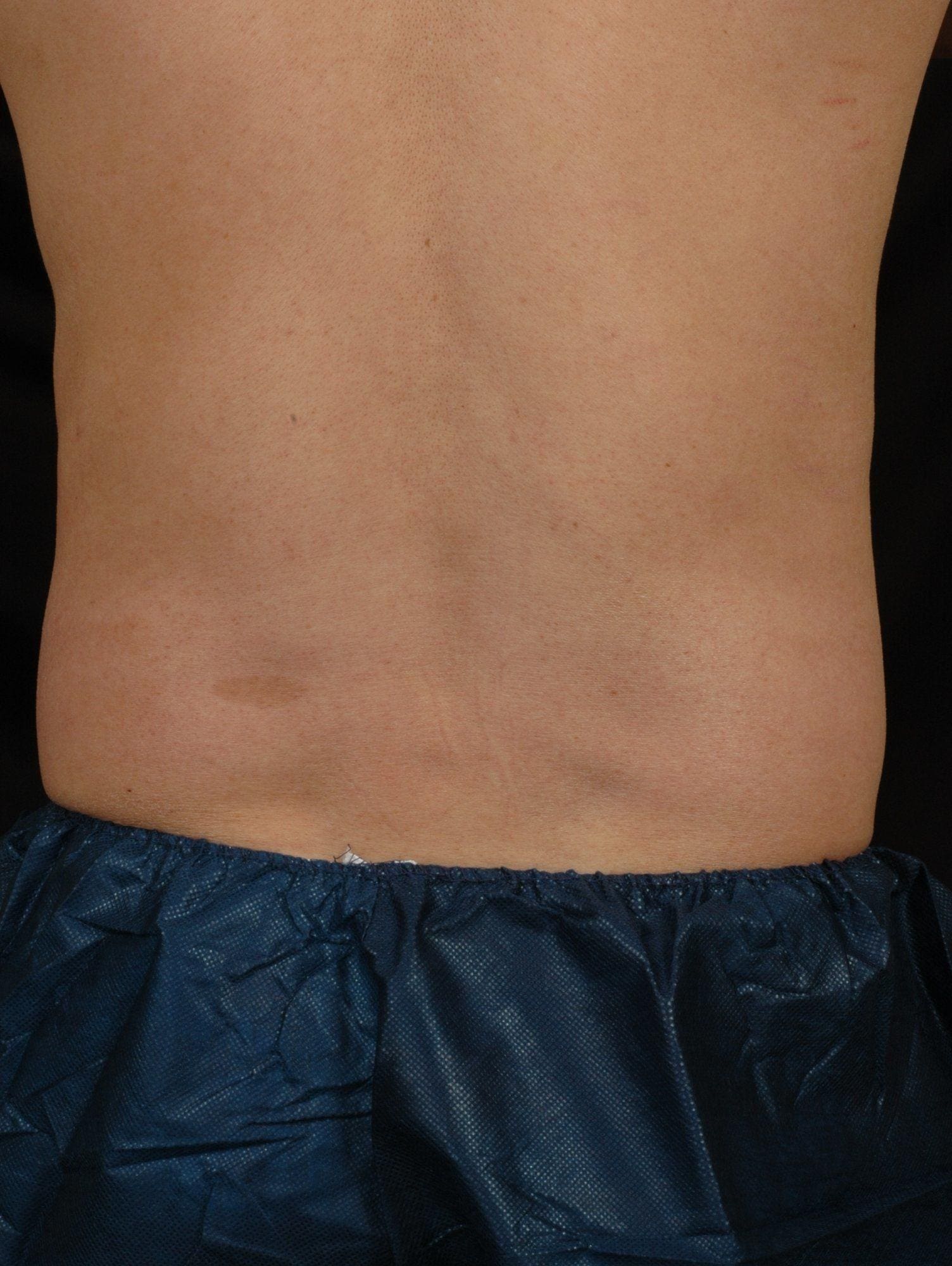 CoolSculpting Patient Photo - Case 13734 - after view-1