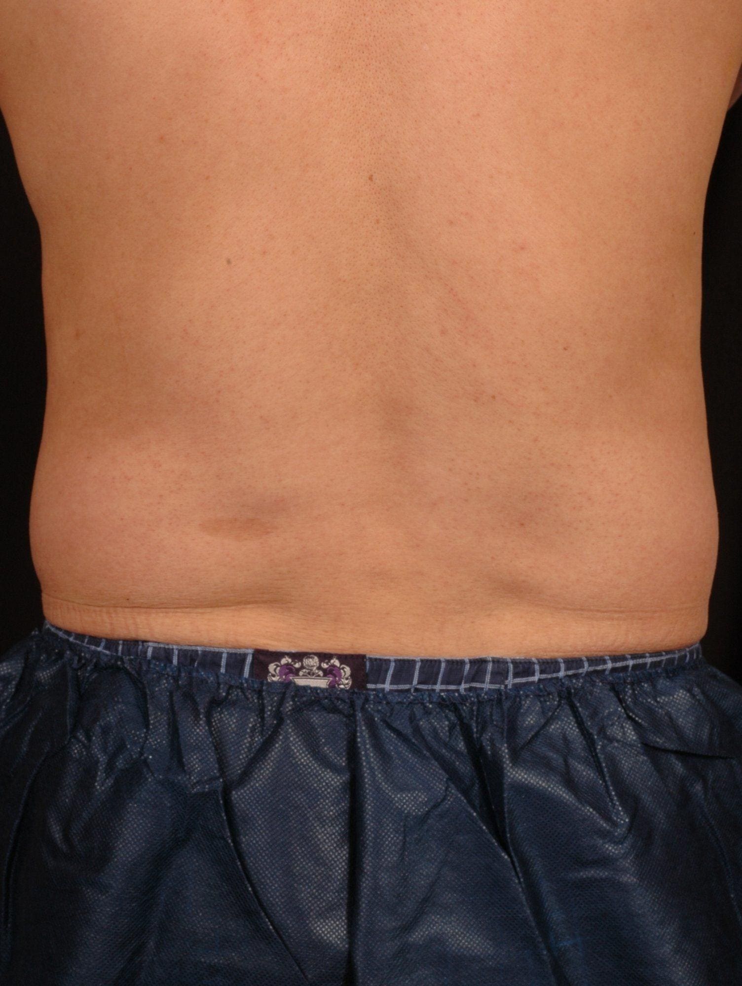 CoolSculpting Patient Photo - Case 13734 - before view-1