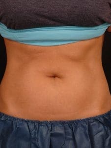 CoolSculpting - Case 13740 - After