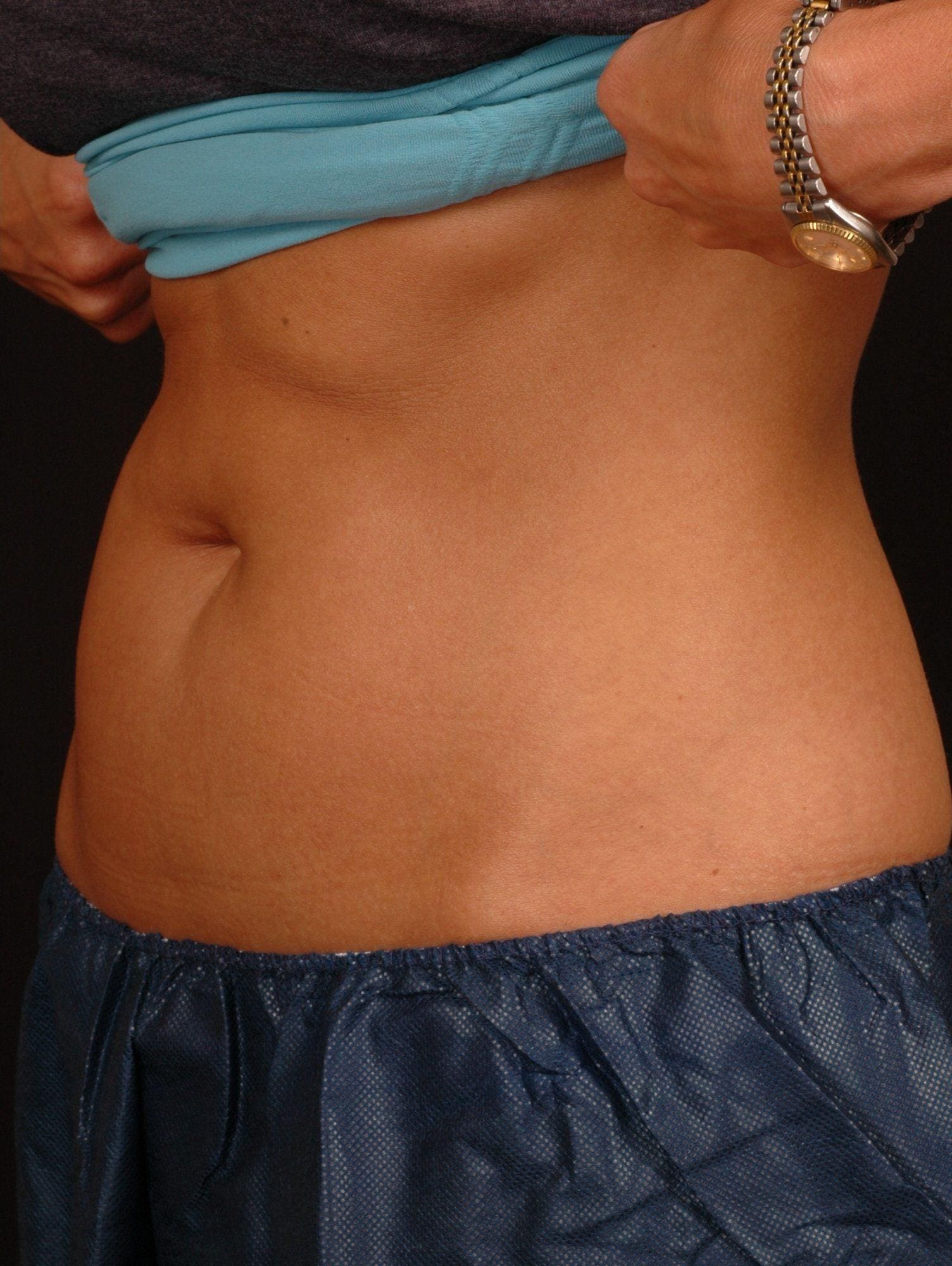 CoolSculpting Patient Photo - Case 13740 - after view-1