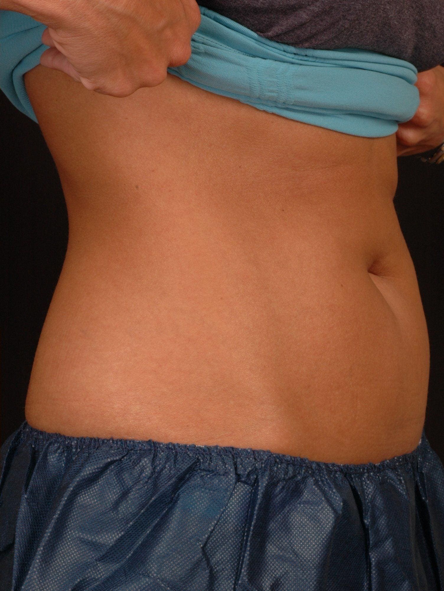 CoolSculpting Patient Photo - Case 13740 - after view-2