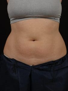 CoolSculpting - Case 13748 - Before