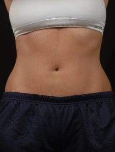 CoolSculpting - Case 13748 - After