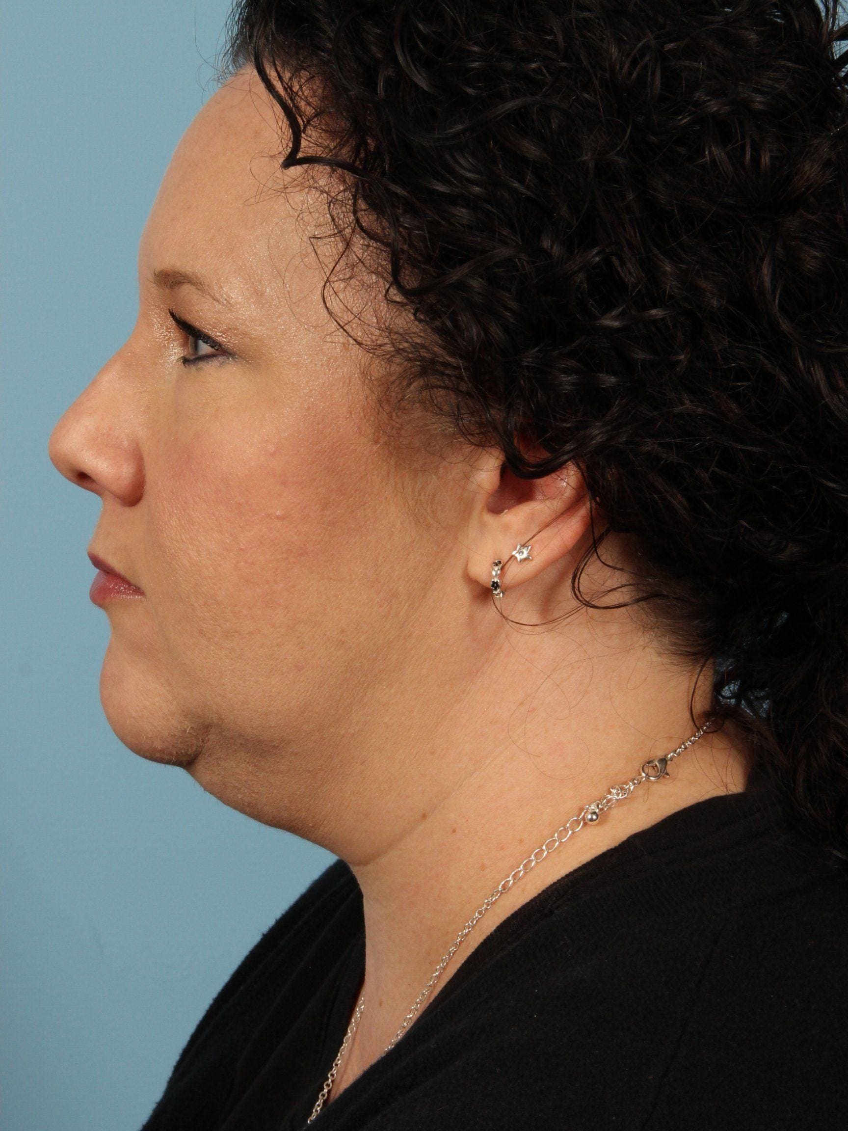 CoolSculpting Patient Photo - Case 13757 - after view-1