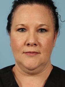 CoolSculpting - Case 13757 - Before