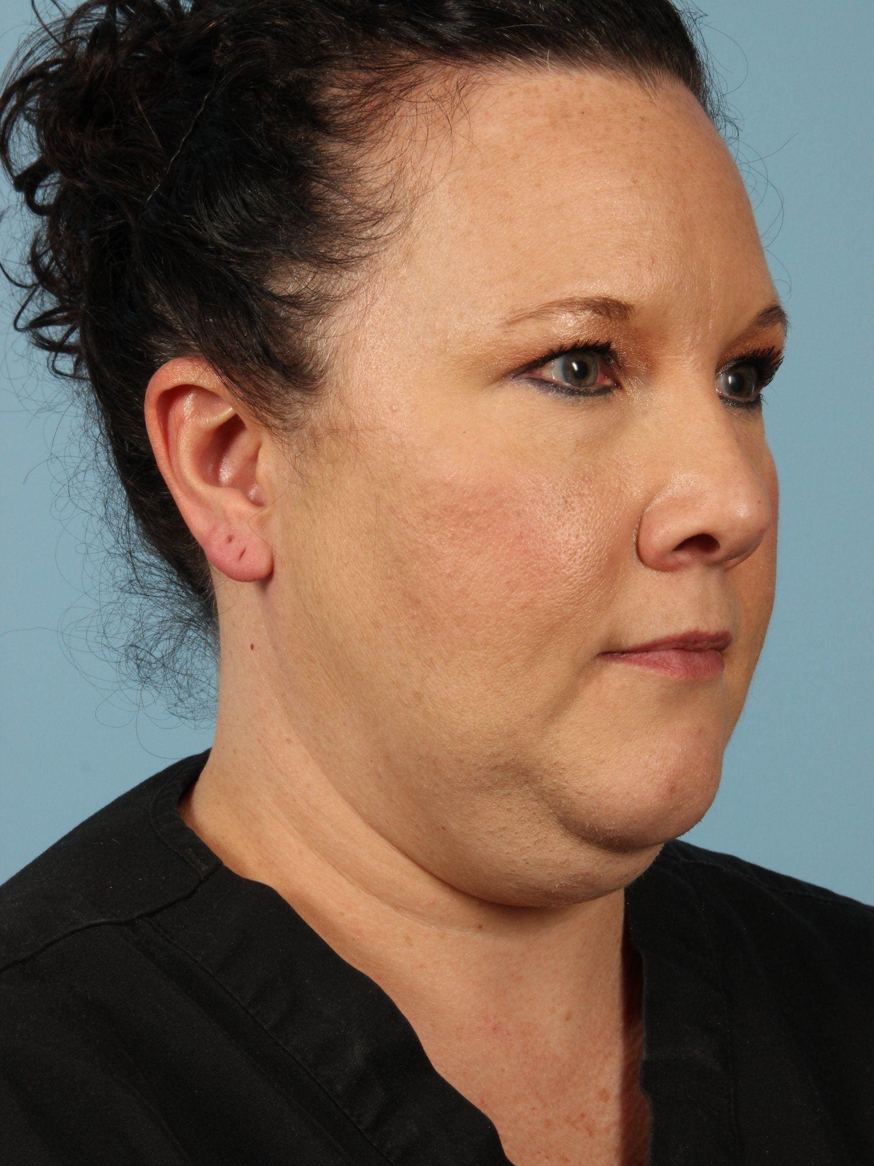 CoolSculpting Patient Photo - Case 13757 - before view-4
