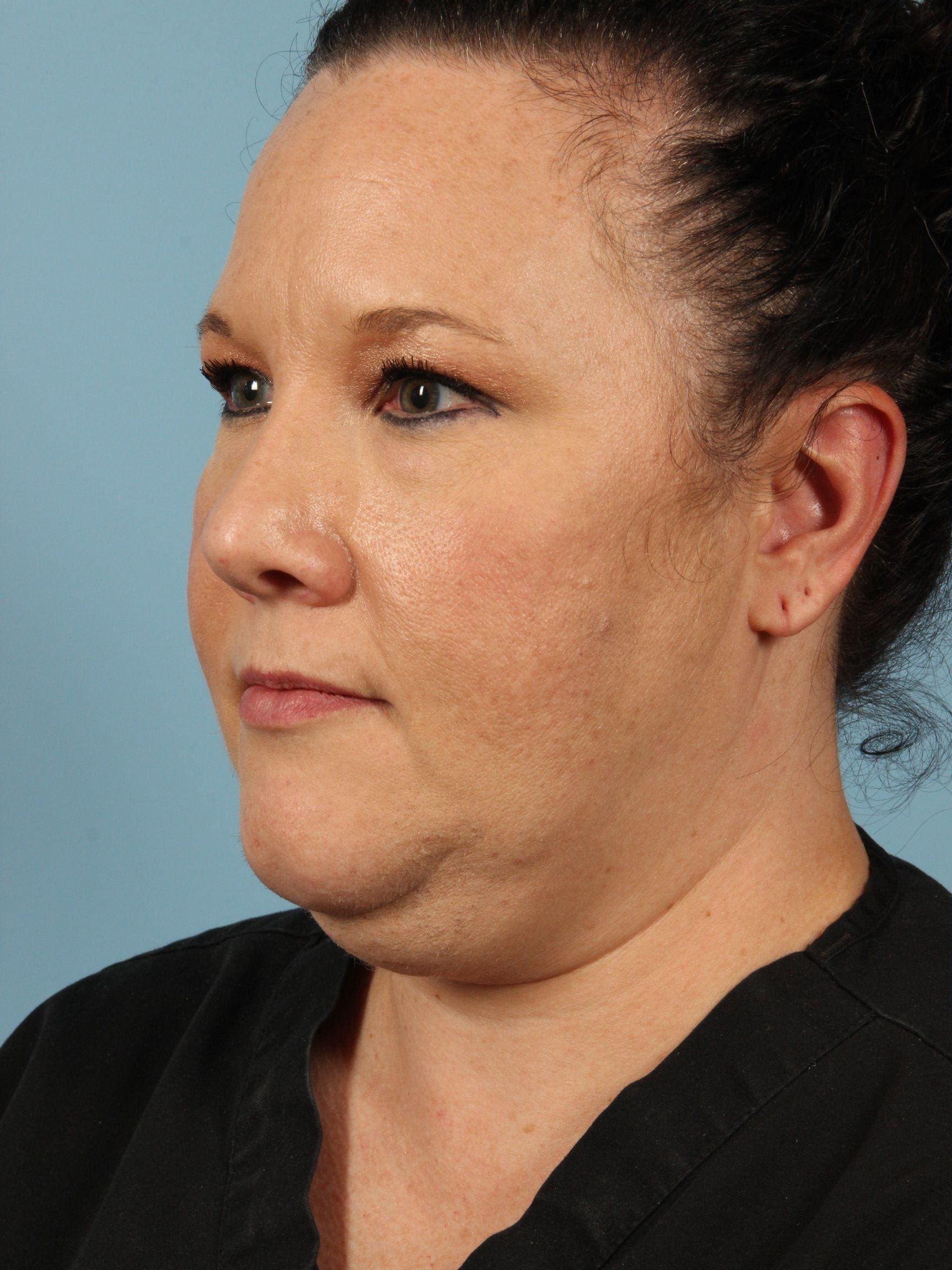 CoolSculpting Patient Photo - Case 13757 - before view-3