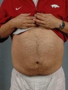 CoolSculpting - Case 13769 - Before