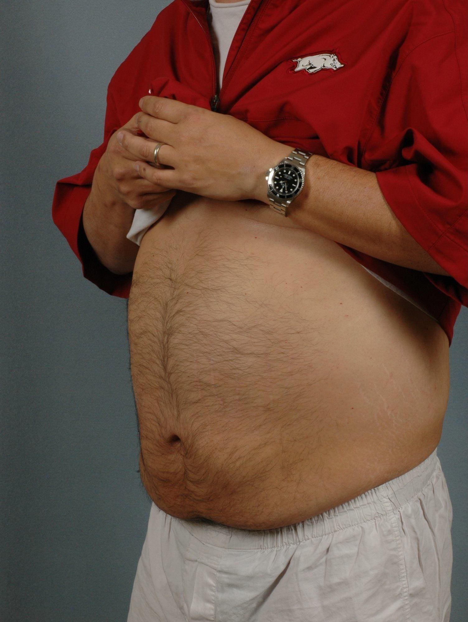 CoolSculpting Patient Photo - Case 13769 - before view-1
