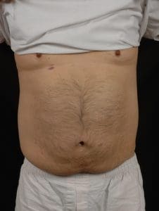 CoolSculpting - Case 13769 - After
