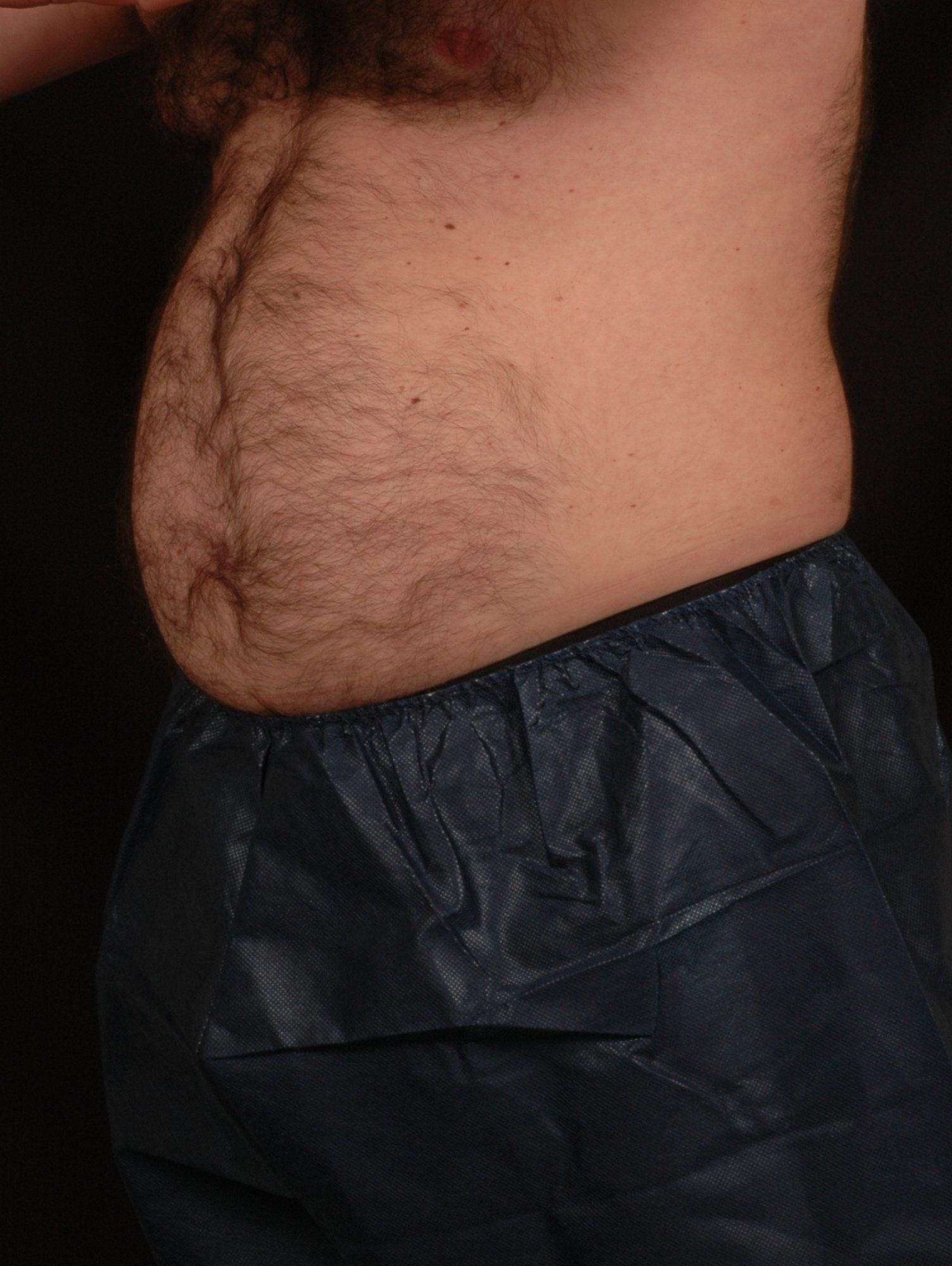 CoolSculpting Patient Photo - Case 13775 - before view-1