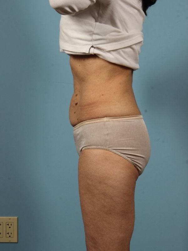 CoolSculpting Patient Photo - Case 13787 - after view-1