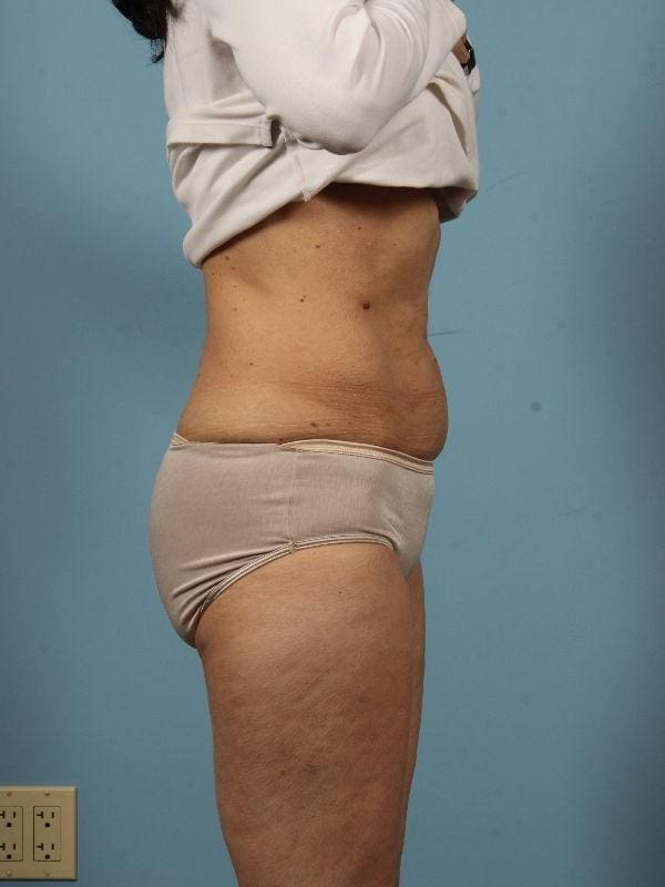 CoolSculpting Patient Photo - Case 13787 - after view-2