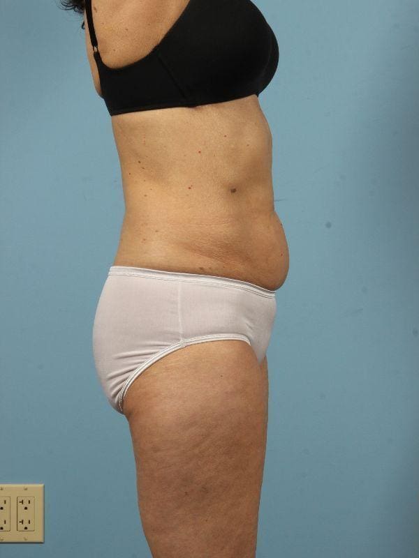 CoolSculpting Patient Photo - Case 13787 - before view-2