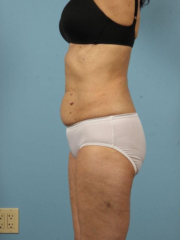 CoolSculpting Patient Photo - Case 13787 - before view-1