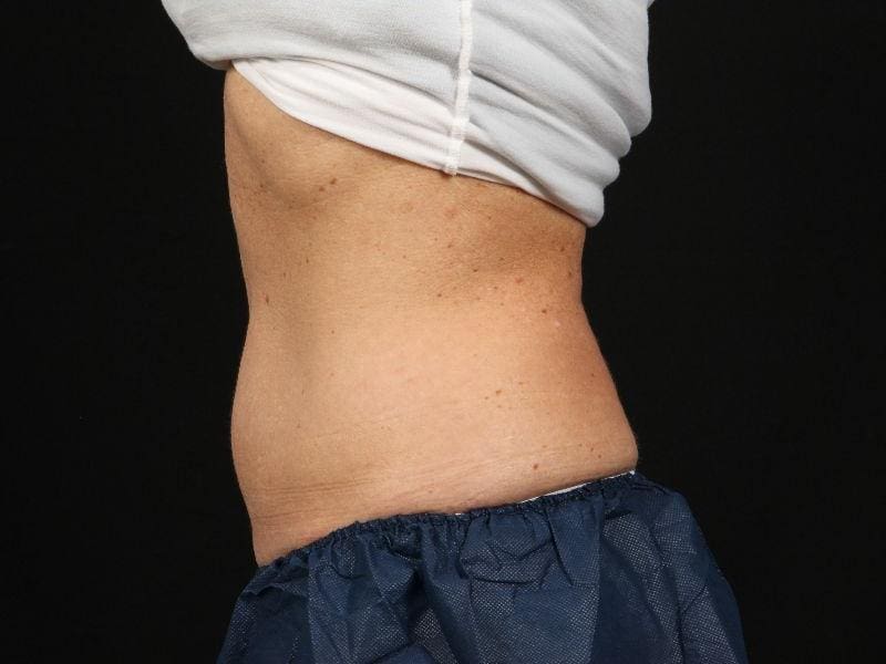 CoolSculpting Patient Photo - Case 13795 - after view-1
