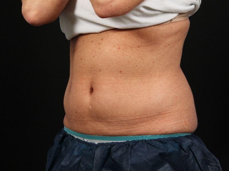 CoolSculpting Patient Photo - Case 13795 - before view-3
