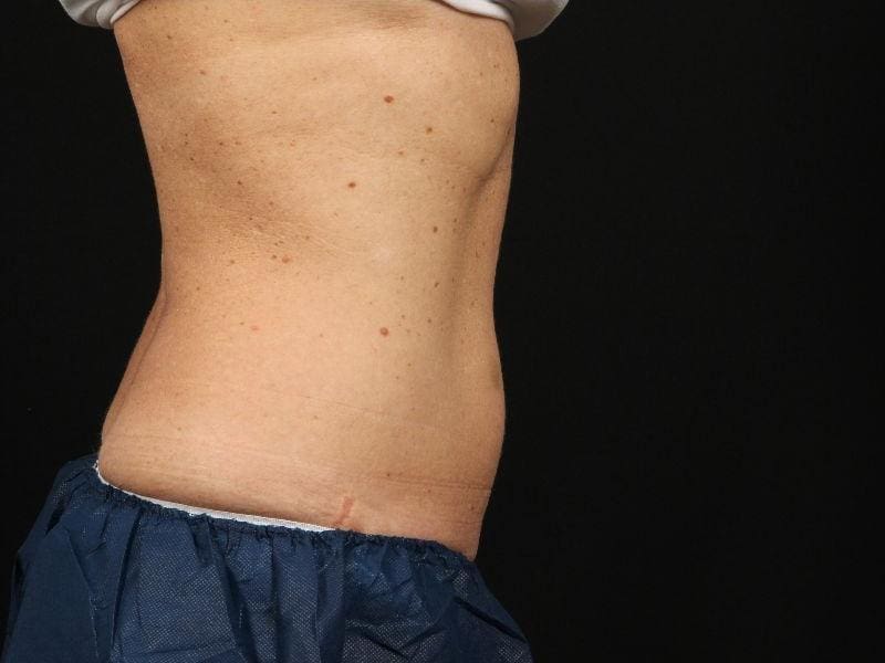 CoolSculpting Patient Photo - Case 13795 - after view-2
