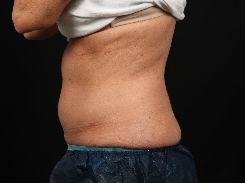 CoolSculpting Patient Photo - Case 13795 - before view-1