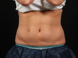 CoolSculpting - Case 13795 - Before