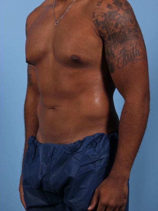 CoolSculpting Patient Photo - Case 13808 - after view-3