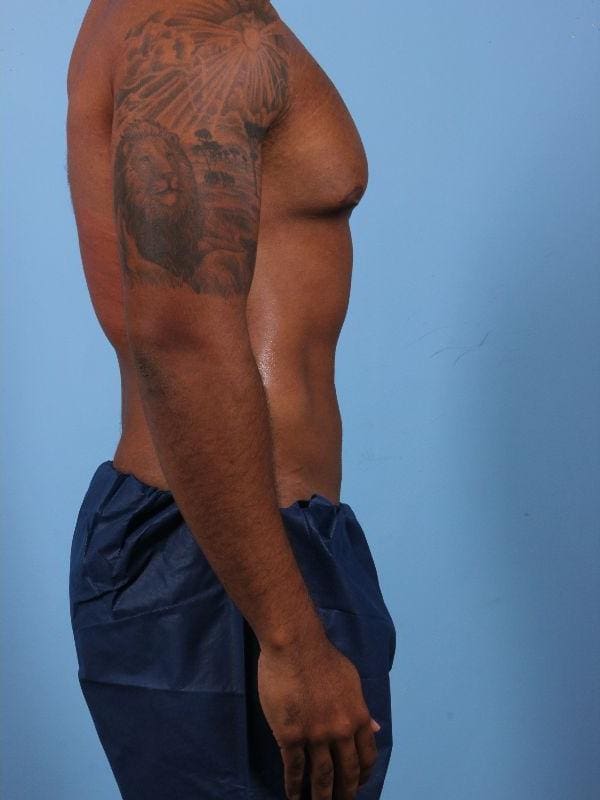 CoolSculpting Patient Photo - Case 13808 - after view-2