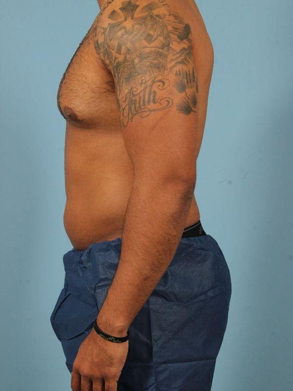 CoolSculpting Patient Photo - Case 13808 - before view-1