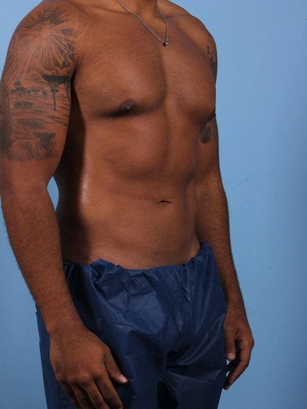 CoolSculpting Patient Photo - Case 13808 - after view-4