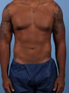 CoolSculpting - Case 13808 - After