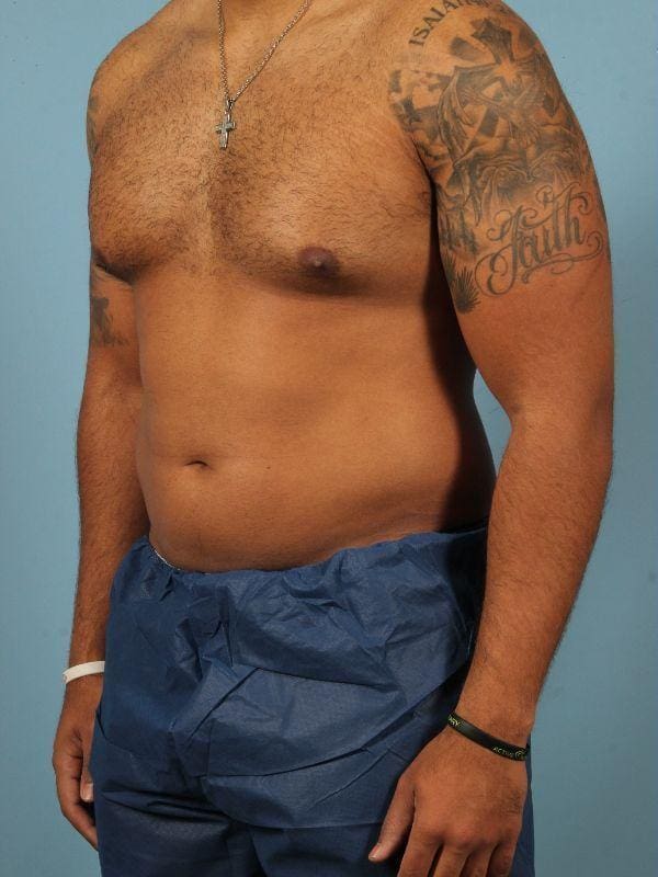 CoolSculpting Patient Photo - Case 13808 - before view-3