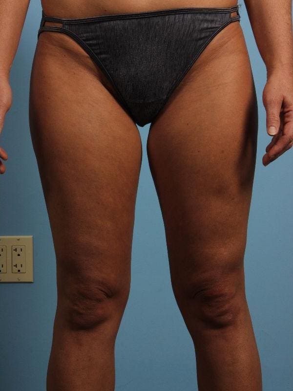 CoolSculpting Patient Photo - Case 13820 - after view