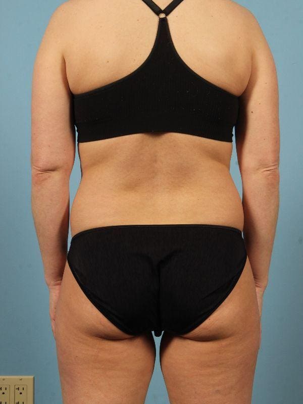 CoolSculpting Patient Photo - Case 13820 - before view-1