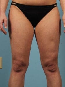 CoolSculpting - Case 13820 - Before